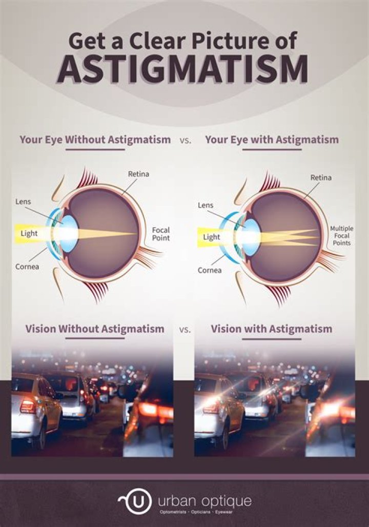Does astigmatism cause diplopia?