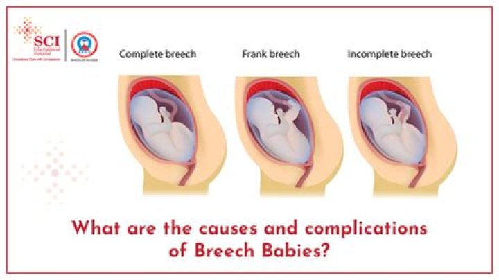 Does breech baby mean abnormalities?