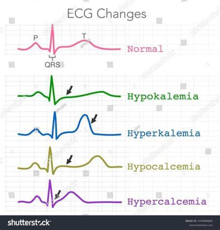 Does hypercalcemia increase heart rate?