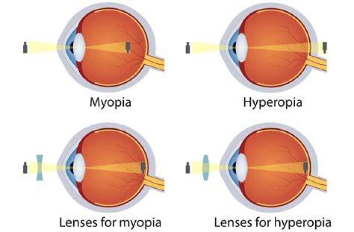 Does hyperopia get worse?