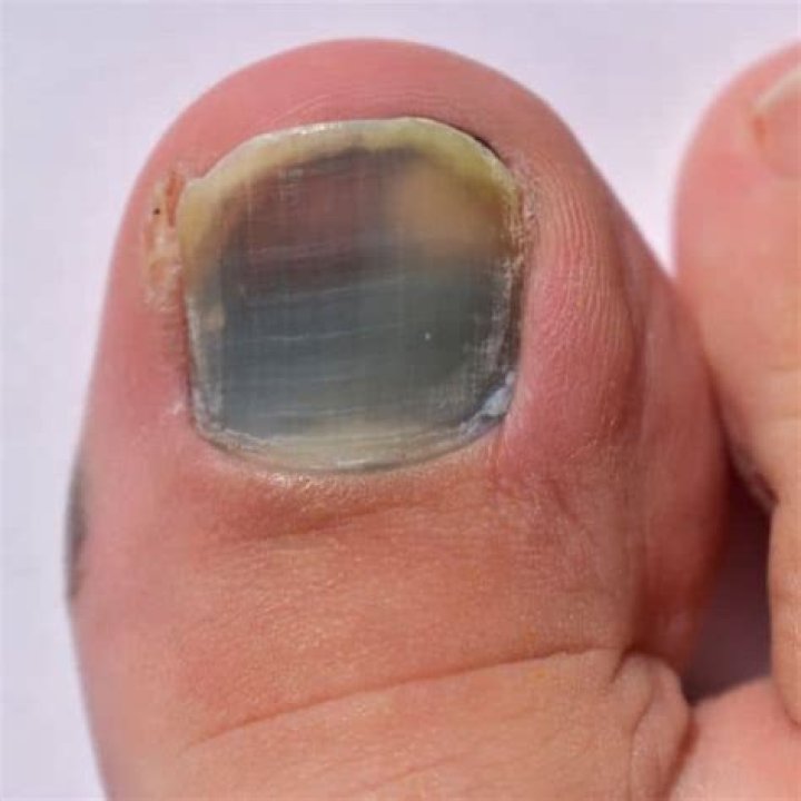 Does it hurt to pull off a toenail?