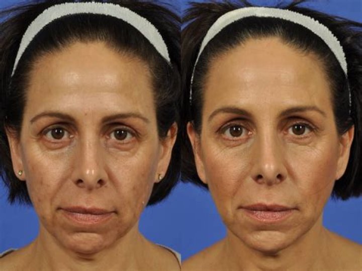 Does tear trough filler get rid of lines?
