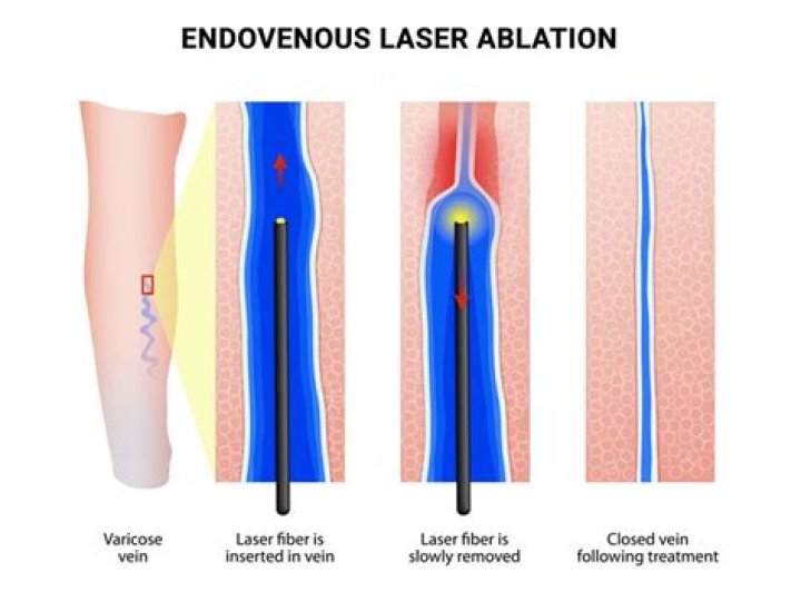 Does vein ablation help circulation?
