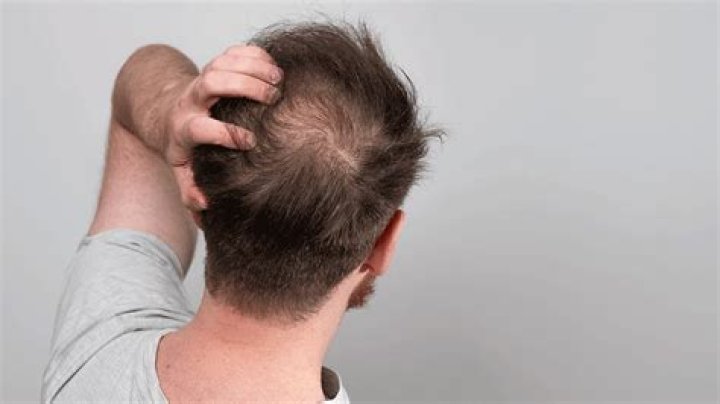Does vinblastine cause hair loss?