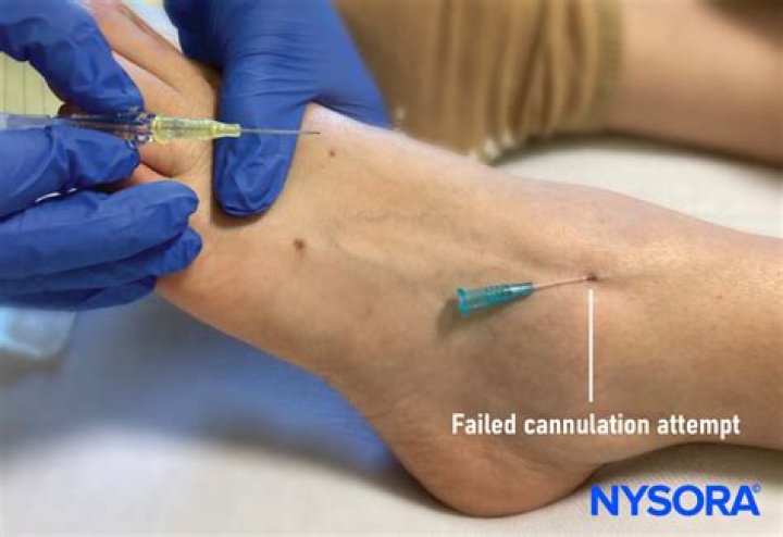 During venipuncture a hematoma may result from?