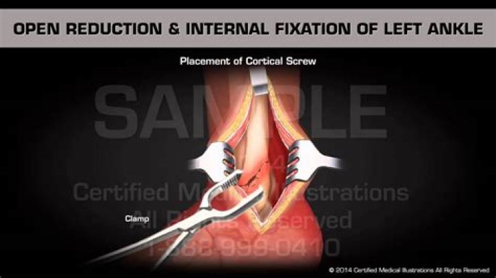 For open reduction internal fixation?