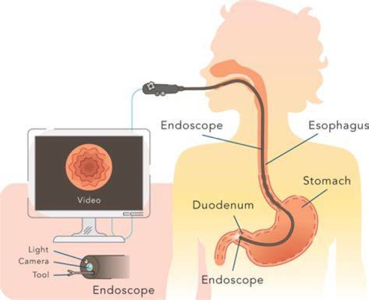 Has anybody died from an endoscopy?