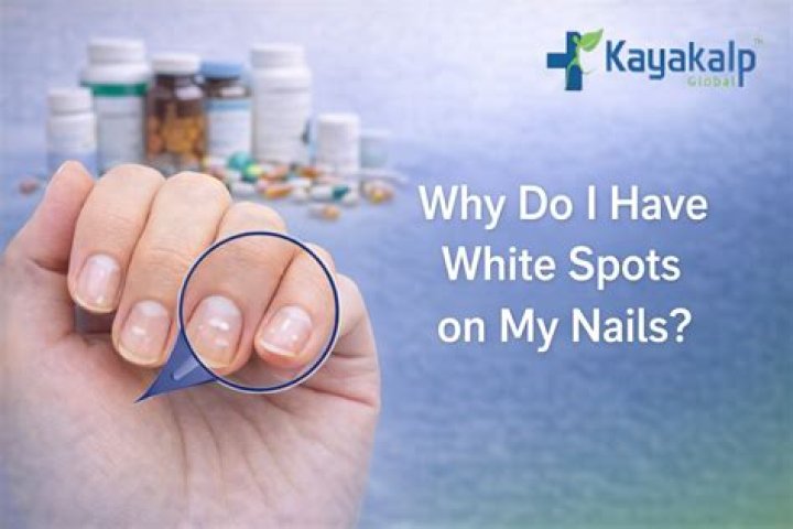 How can i stop squeezing my spots?
