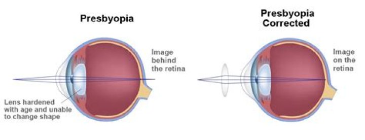 How can presbyopia be corrected?