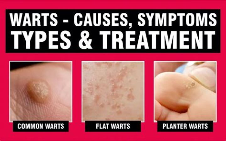 How do you get warts?