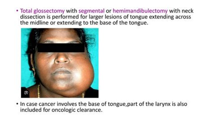 How is a glossectomy performed?