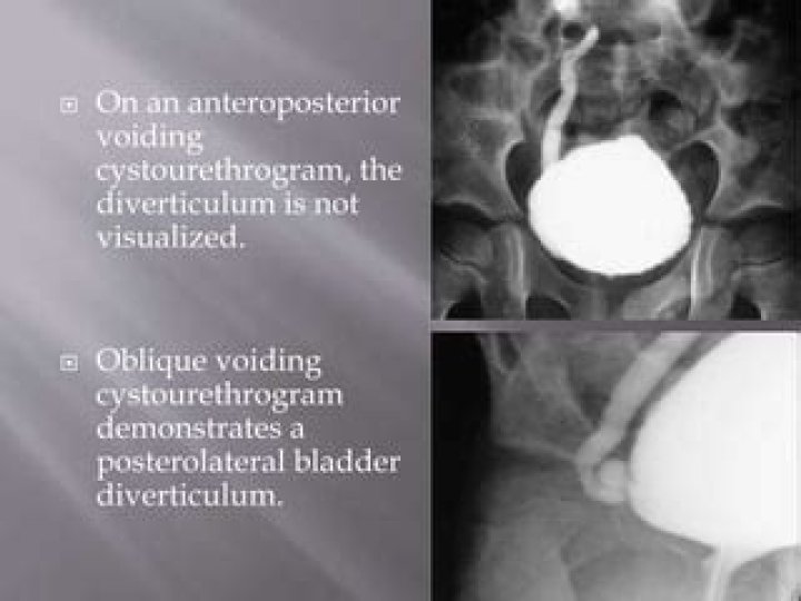 How is micturating cystourethrogram done?