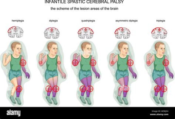 How is spastic cerebral palsy causes?