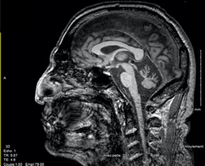 How is spinocerebellar ataxia diagnosed?