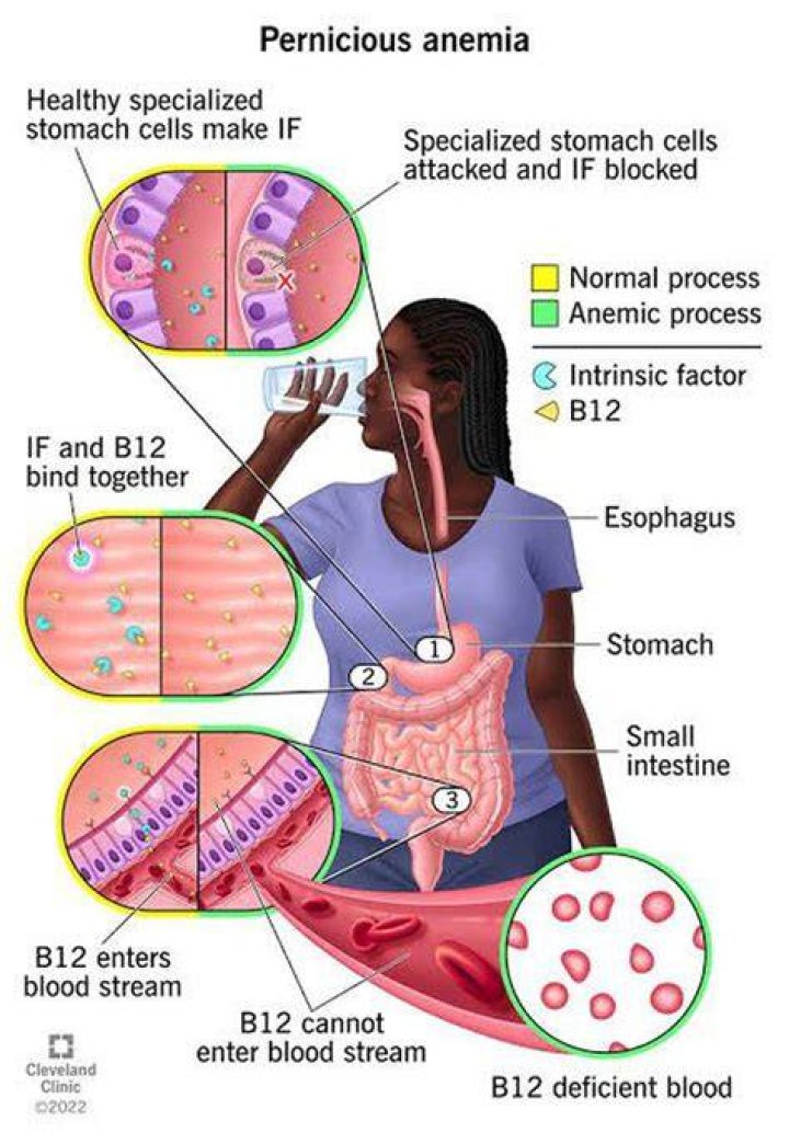 How pernicious anemia cause stomach cancer?