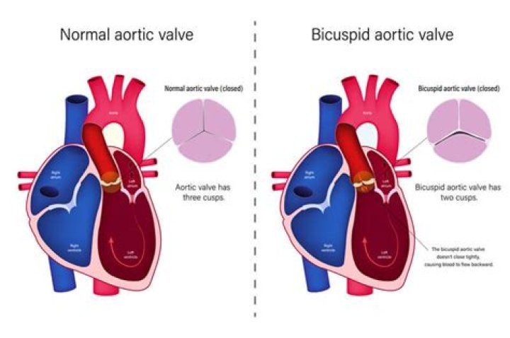 How rare is a bicuspid aortic valve?