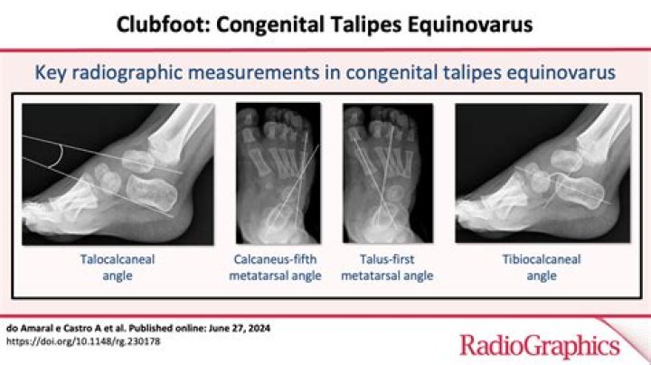 How to detect talipes equinovarus?