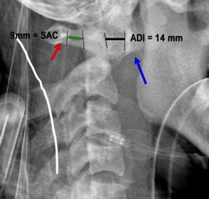 How to measure atlantoaxial instability?
