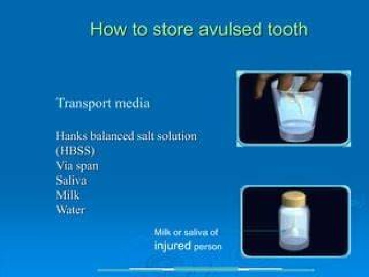 How to store avulsed tooth?