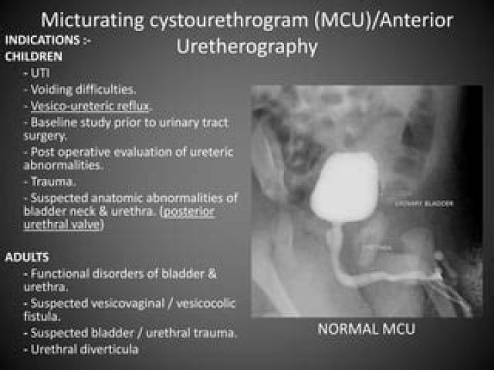 Indications for micturating cystourethrogram?