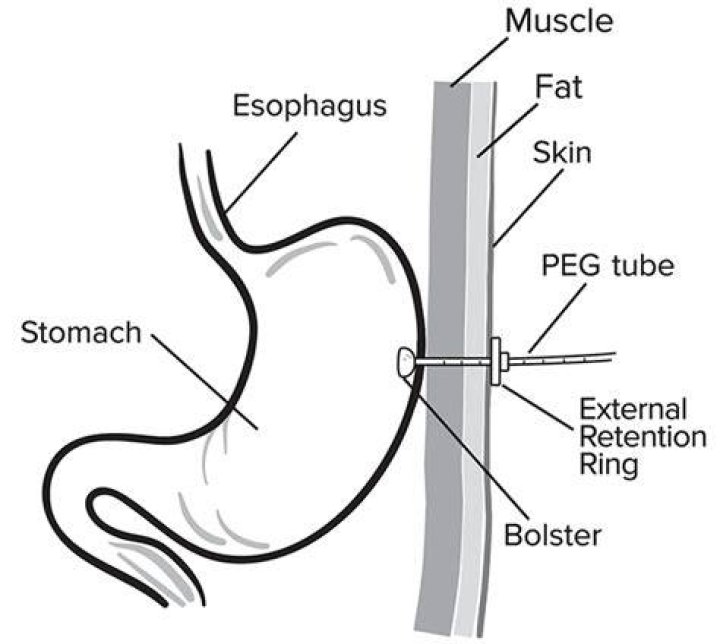 Is a peg tube a gastrostomy?