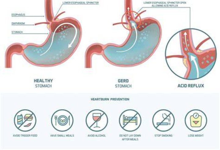 Is acid reflux dangerous?