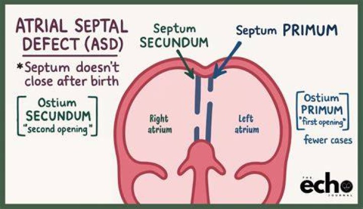 Is atrial septal defect secundum?