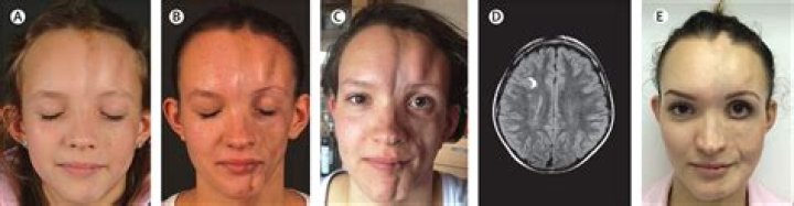 Is facial hemiatrophy hereditary?