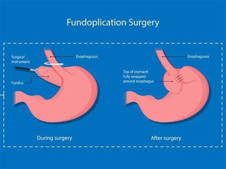 Is fundoplication a major surgery?