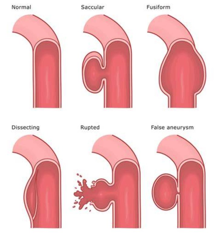 Is fusiform aneurysm dangerous?