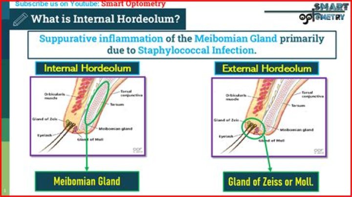 Is internal hordeolum contagious?