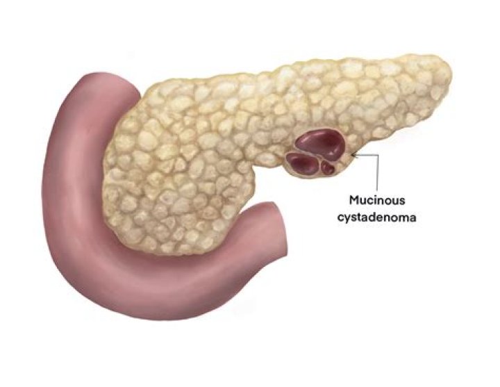 Is mucinous cystadenoma cancerous?