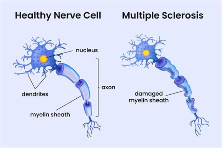 Is multiple sclerosis passed down to the family?
