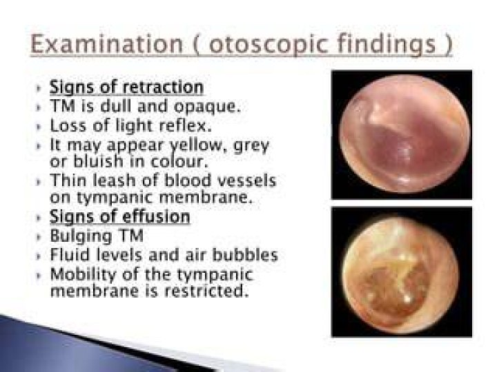 Is retracted eardrum serious?
