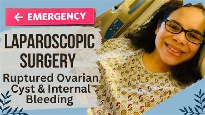 Is ruptured ovarian cyst an emergency?