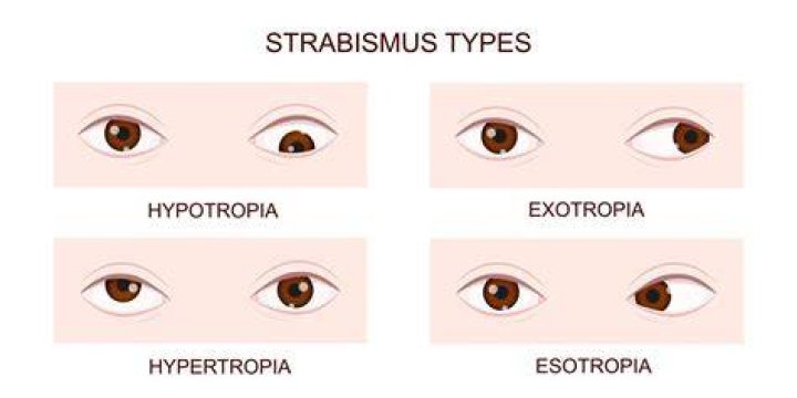 Is strabismus and tropia?