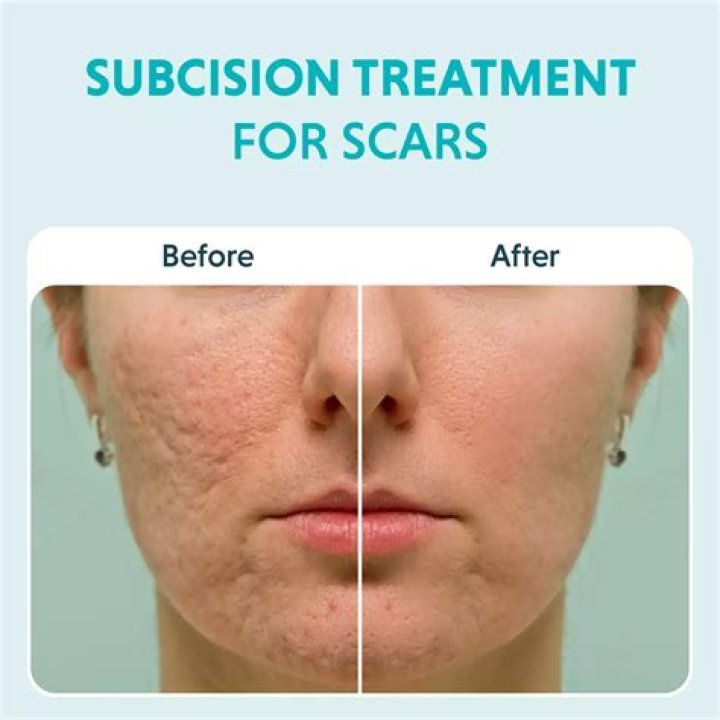 Is subcision good for acne scars?