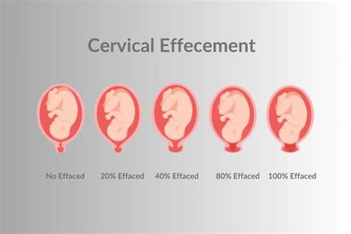 Is thinned and effaced the same thing?