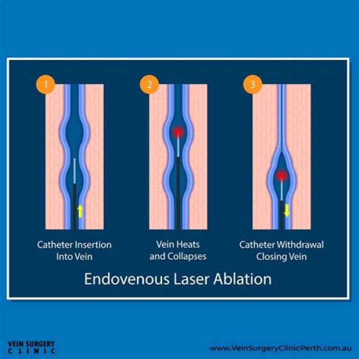 Is vein ablation surgery?
