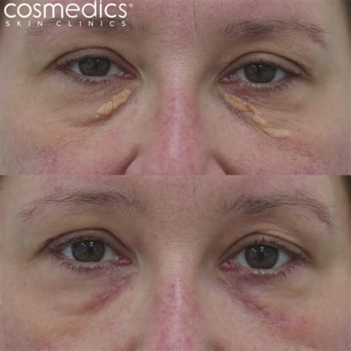 Is xanthelasma removal covered by insurance?