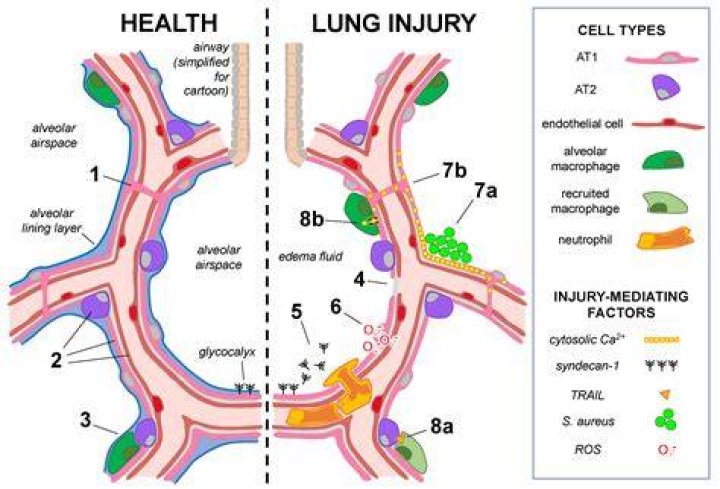 What's cirrhosis of the lungs?