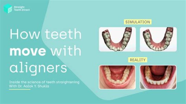 What are aligners made of?