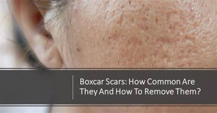 What are boxcar scars?