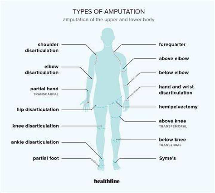 What are the types of amputation?