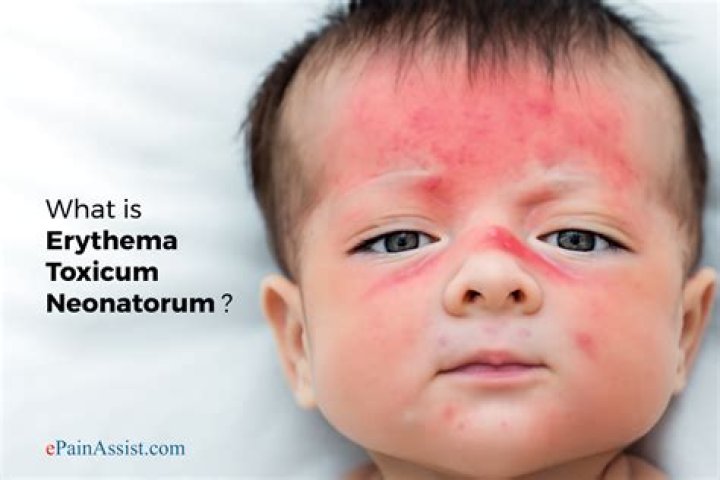 What causes erythema toxicum?