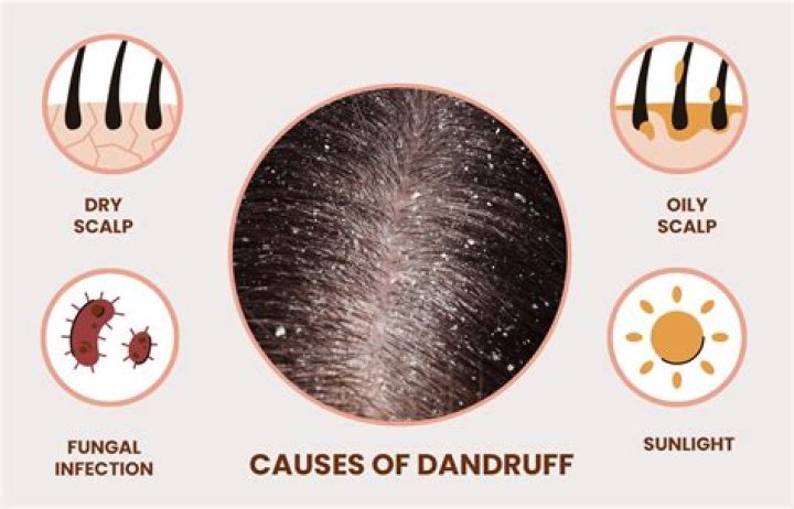 What dandruff looks like?