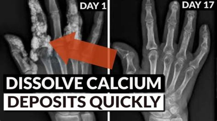What dissolves calcium deposits in the body?