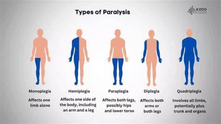 What does the suffix plegia mean?