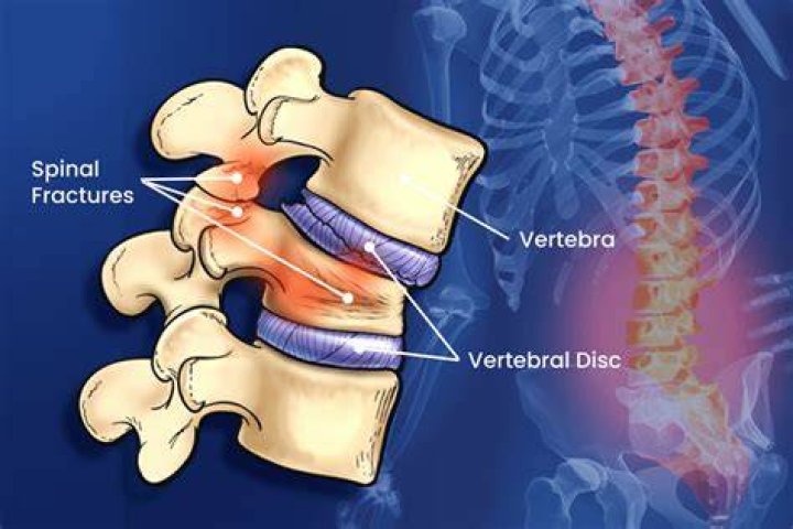 What is a broken spine?