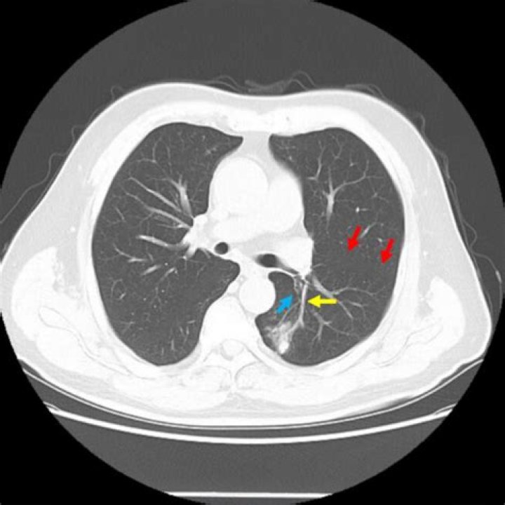 What is a fissural nodule?